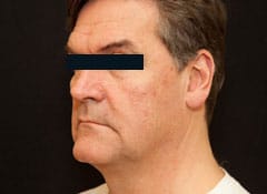 ThermiTight Skin Tightening Westborough MA | Worcester MA ThermiTight Skin Tightening Westborough MA | Worcester MA