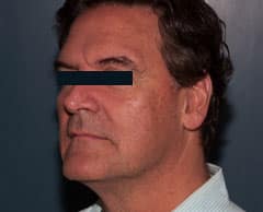 ThermiTight Skin Tightening Westborough MA | Worcester MA ThermiTight Skin Tightening Westborough MA | Worcester MA