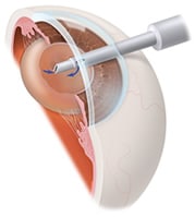 Lens