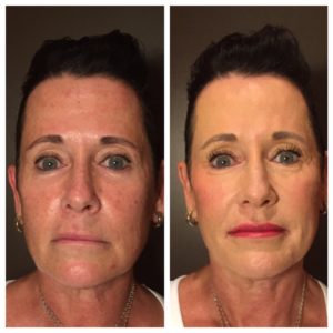Voluma Patient Before & After Voluma Patient Before & After