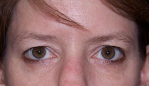Eyelid Surgery Before | Blepharoplasty |Westborough MA | Boston Eyelid Surgery Before | Blepharoplasty |Westborough MA | Boston