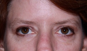 Eyelid Surgery After | Blepharoplasty |Westborough MA | Boston Eyelid Surgery After | Blepharoplasty |Westborough MA | Boston