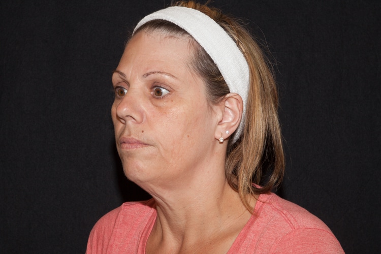Kybella | Double Chin Treatment Westborough MA | Worcester MA Kybella | Double Chin Treatment Westborough MA | Worcester MA
