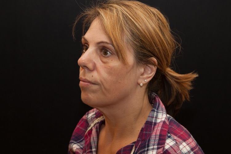 Kybella | Double Chin Treatment Westborough MA | Worcester MA Kybella | Double Chin Treatment Westborough MA | Worcester MA