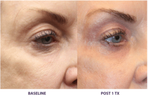 Eyelid Lift