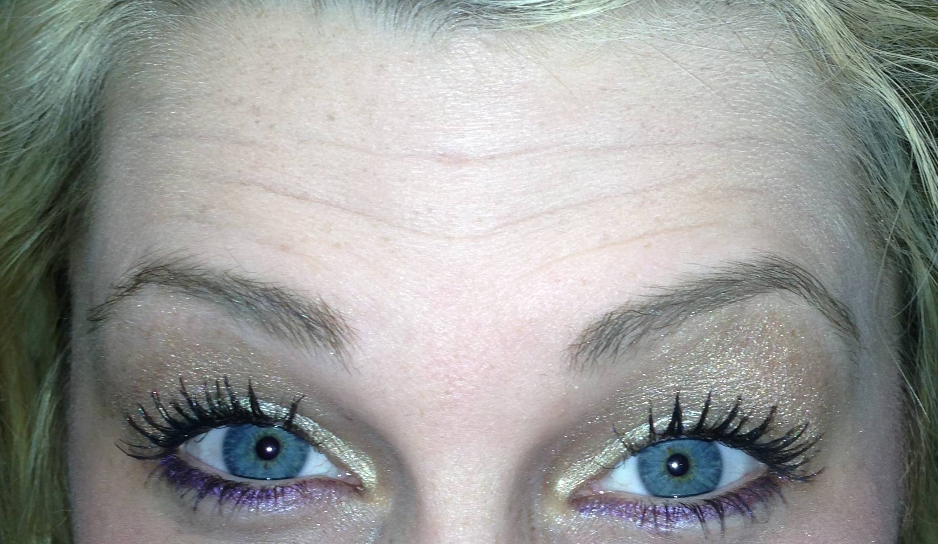 wrinkled forehead of blue-eyed woman before Botox