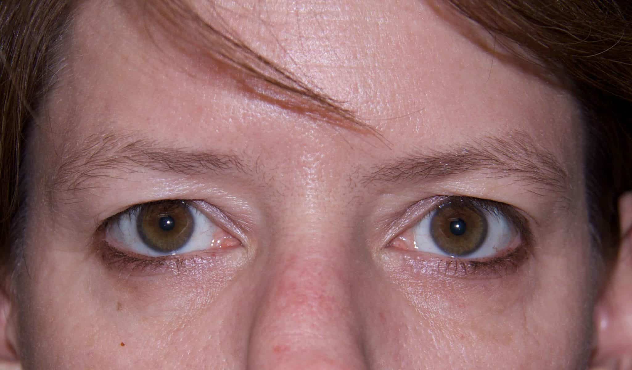 Eyelid Surgery