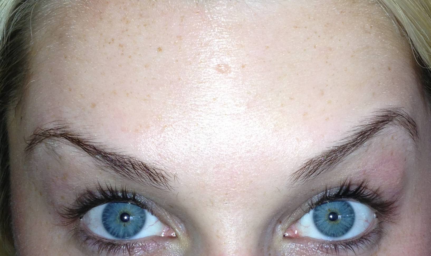 blue-eyed woman’s forehead with no wrinkles after Botox treatment