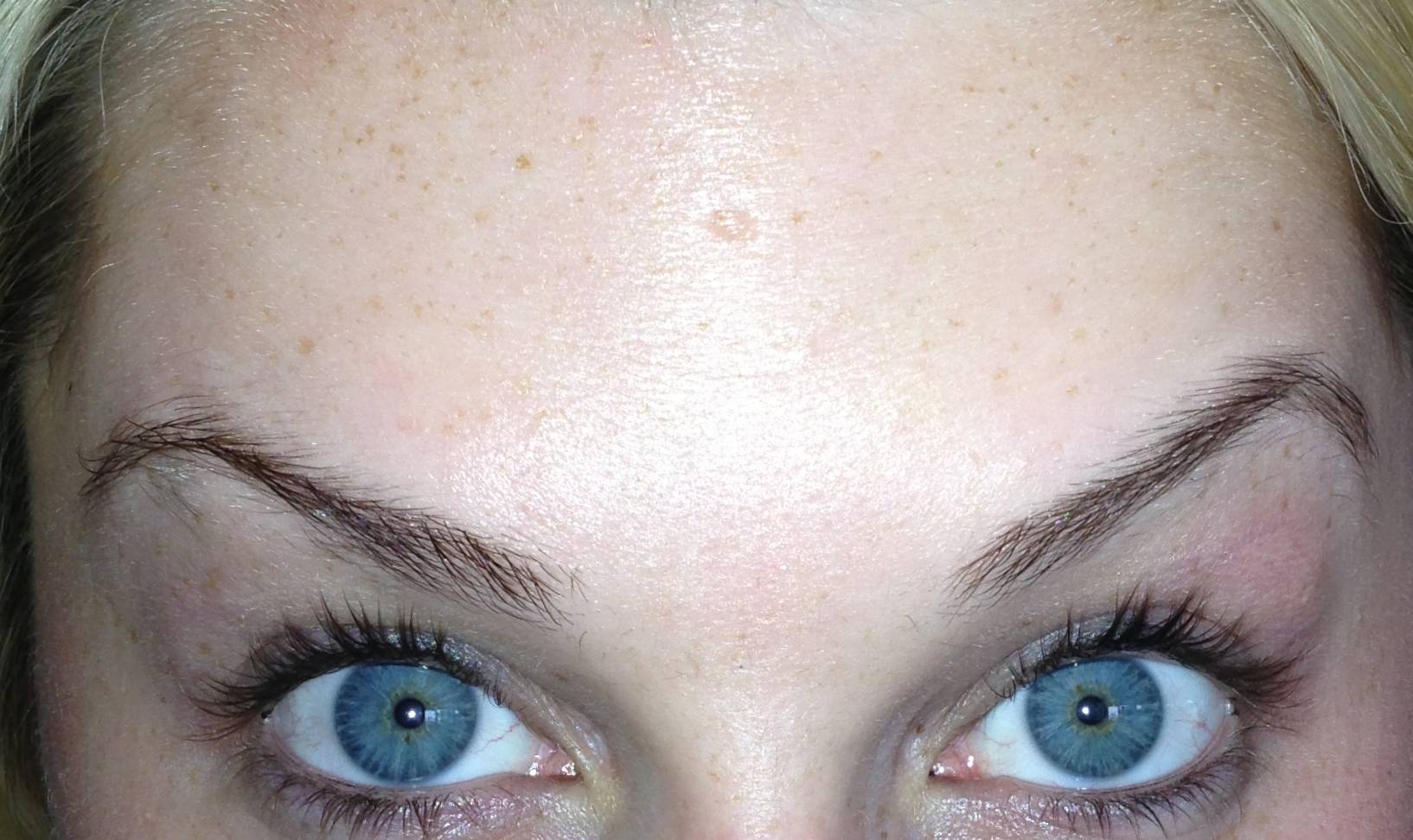 Botox
