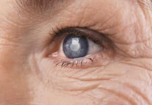 Close up of an elderly person's eye with cataracts spreading, in need of cataract surgery to improve vision